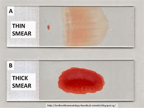 thick and thin smear test|thick blood film identification.